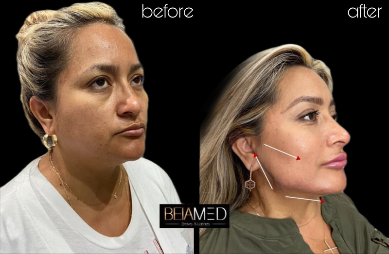 Beiamed - Nose Contour  Rhynogesis In this technique, we